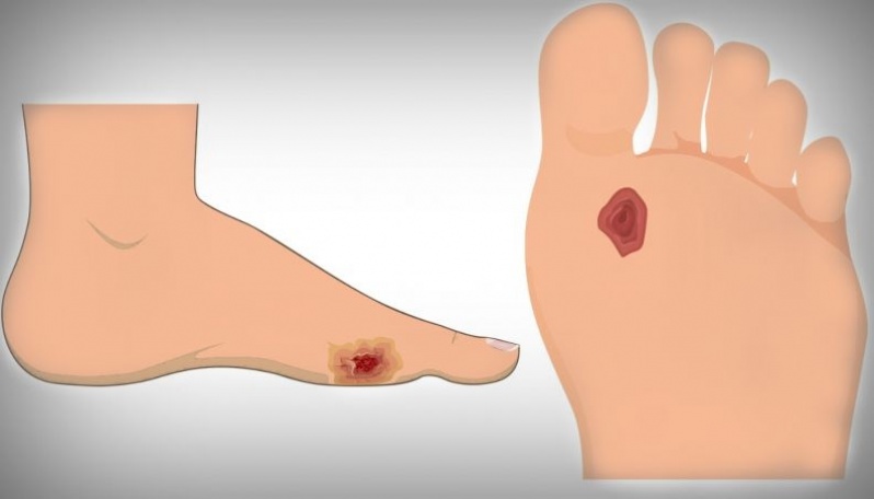 Clínica de Podologia para Diabéticos em Sp Luz - Clínica de Podologia para Infecção de Unhas