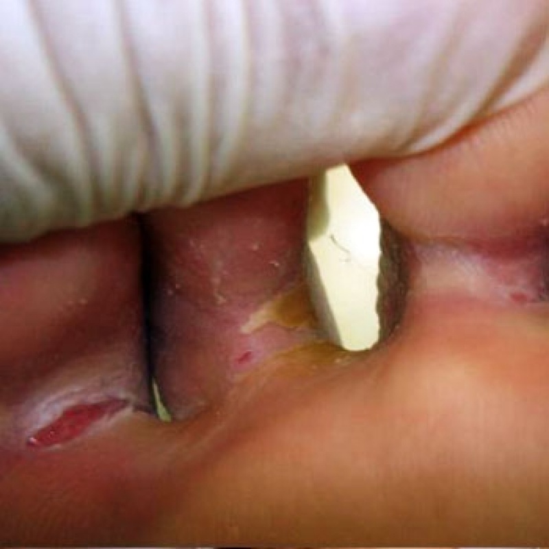 Clínica para Tratamento contra Rachaduras entre Os Dedos Campo Grande - Tratamento de Rachadura no Pé
