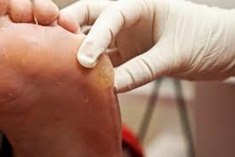Clínica para Tratamento de Calos e Calosidades Brooklin - Tratamento de Calos entre Os Dedos