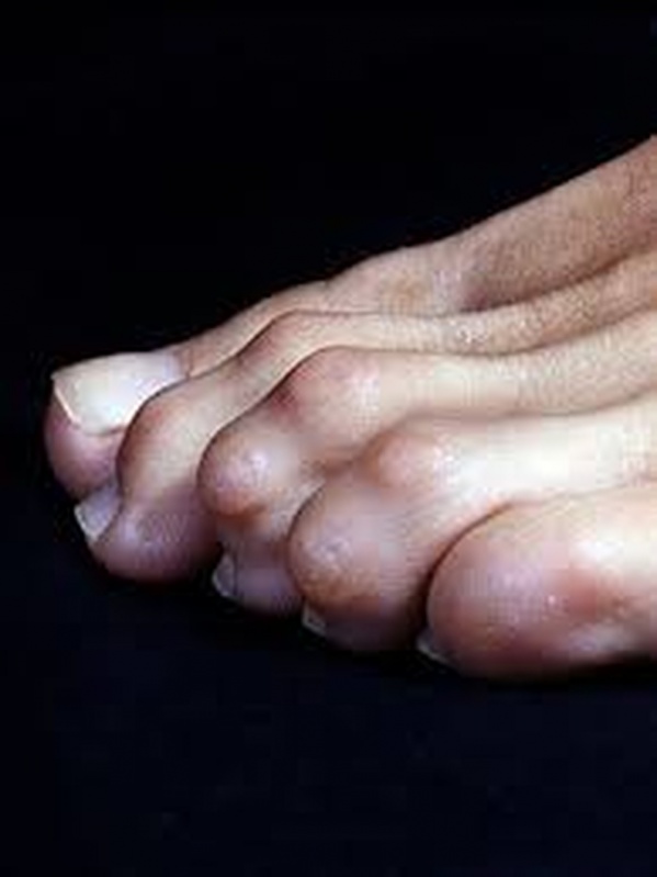 Clínica para Tratamento de Calos nos Dedos dos Pés Jabaquara - Tratamento de Calos na Sola do Pé