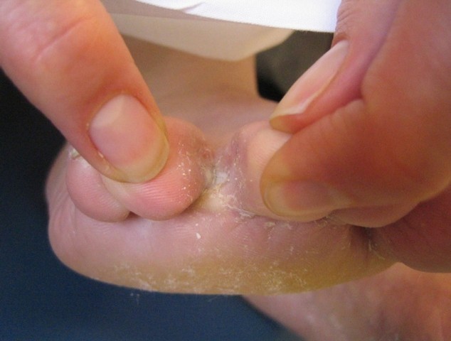 Cotação de Tratamento contra Fungo nas Unhas Vila Sônia - Tratamento de Micose entre Os Dedos