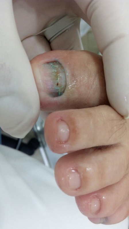 Cotação de Tratamento de Micose de Unha Brás - Tratamento de Micose entre Os Dedos
