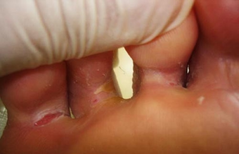 Cotação de Tratamento de Micose entre Os Dedos Campo Belo - Tratamento de Micose de Unha