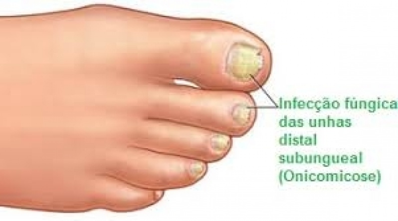 Onde Encontro Podólogo Trata Micose de Unha São Domingos - Podólogo Trata Micose de Unha