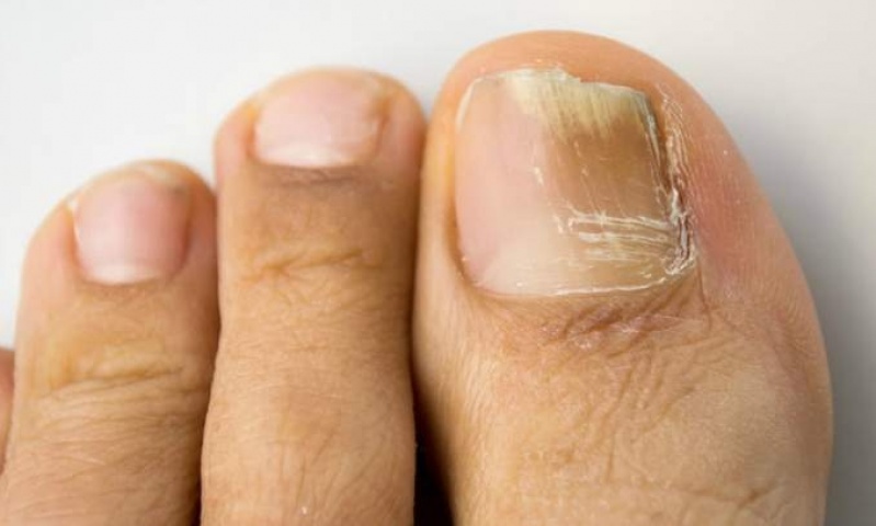 Onde Encontro Tratamento para Unhas Amareladas Sacomã - Tratamento em Pés Sensíveis