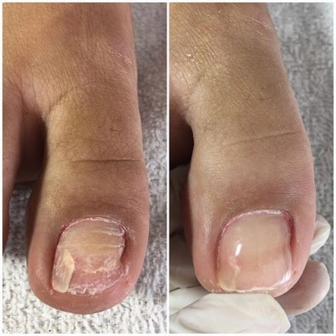 Orçamento de Reconstrução de Unhas Quebradas Bom Retiro - Reconstrução de Unhas com Gel