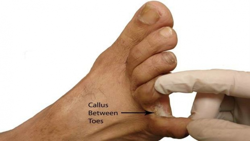 Podólogo para Tratamento de Calos entre Os Dedos Água Funda - Tratamento de Calosidade Plantar