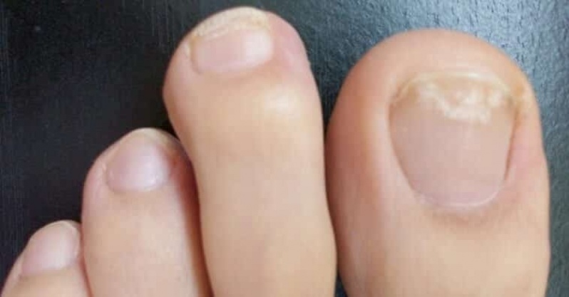 Quanto Custa Tratamentos Dores nas Unhas Água Funda - Tratamento em Pés Sensíveis