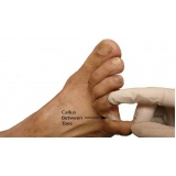 podólogo para tratamento de calos entre os dedos Ibirapuera