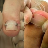 reconstrução das unhas