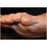 tratamento de calos nos dedos dos pés preço Higienópolis