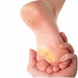 tratamento de calos nos pés Pinheiros