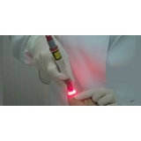 tratamento de micose a laser Jaguaré