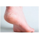 tratamento de rachadura dos pés Aclimação