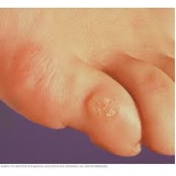 tratamentos de calos nos dedos dos pés Higienópolis