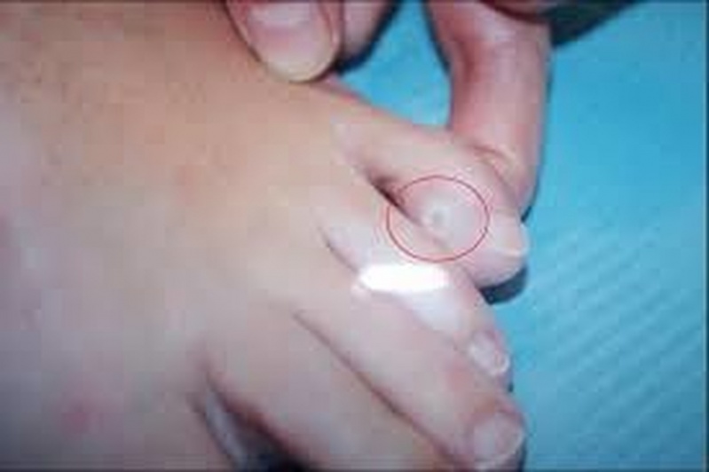 Tratamento de Calos entre Os Dedos Preço Morumbi - Tratamento de Calosidade