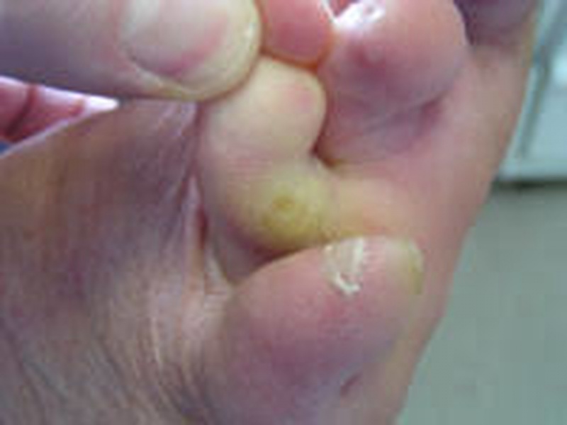 Tratamento de Calos entre Os Dedos Jabaquara - Tratamento de Calos nos Dedos dos Pés