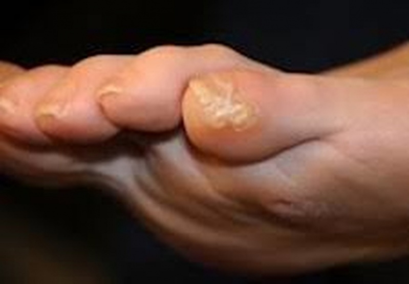 Tratamento de Calos nos Dedos dos Pés Preço Butantã - Tratamento de Calos entre Os Dedos