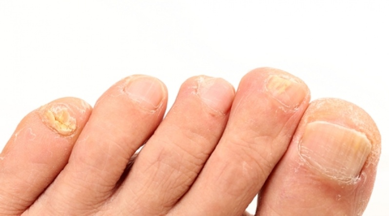 Tratamento de Fungo das Unhas Glicério - Tratamento de Micose entre Os Dedos