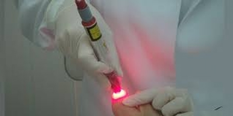 Tratamento de Micose a Laser Jockey Club - Tratamento de Micose entre Os Dedos