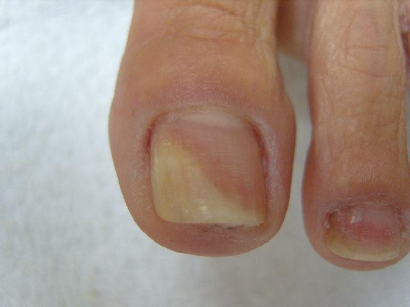 Tratamento de Micose de Unha a Laser Consolação - Tratamento de Micose entre Os Dedos
