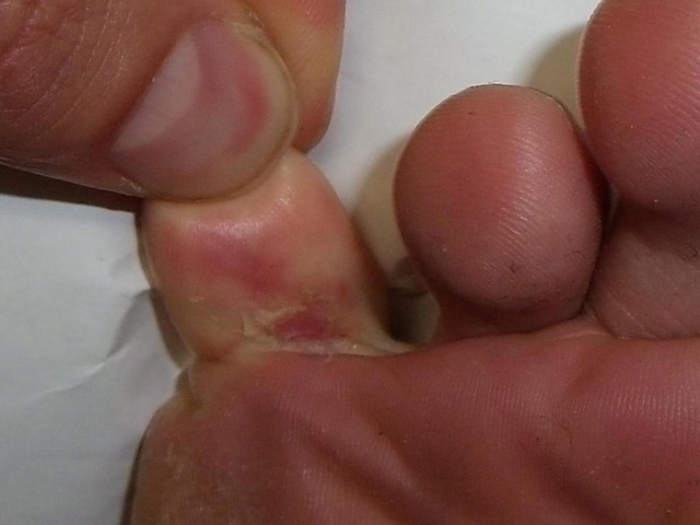 Tratamento de Micose entre Os Dedos Preço Campo Grande - Tratamento para Micose de Unha Grave