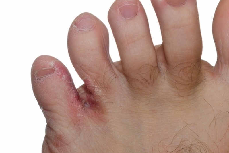 Tratamento de Micose entre Os Dedos Aeroporto - Tratamento de Micose das Unhas