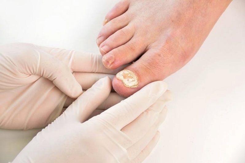 Tratamento Micose de Unha na Gravidez Preço Santa Efigênia - Tratamento de Micose entre Os Dedos
