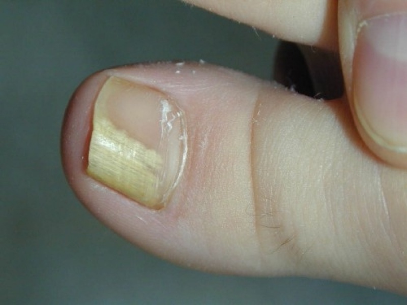 Tratamento para Unhas Amareladas Jabaquara - Tratamentos de Dores nos Dedos dos Pés