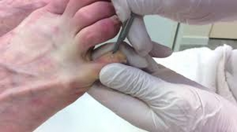 Tratamentos de Calos entre Os Dedos Glicério - Tratamento de Calos nos Pés