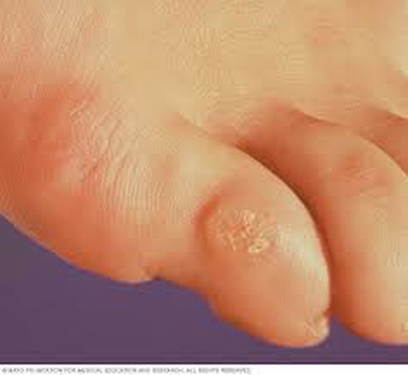 Tratamentos de Calos nos Dedos dos Pés Consolação - Tratamento de Calos nos Dedos dos Pés