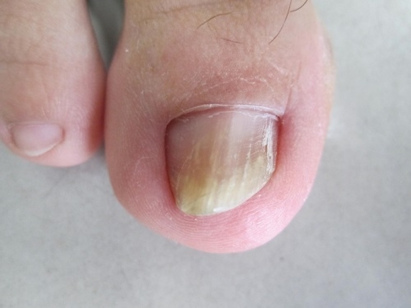 Tratamentos de Fungos das Unhas Jardim Bonfiglioli - Tratamento de Micose entre Os Dedos