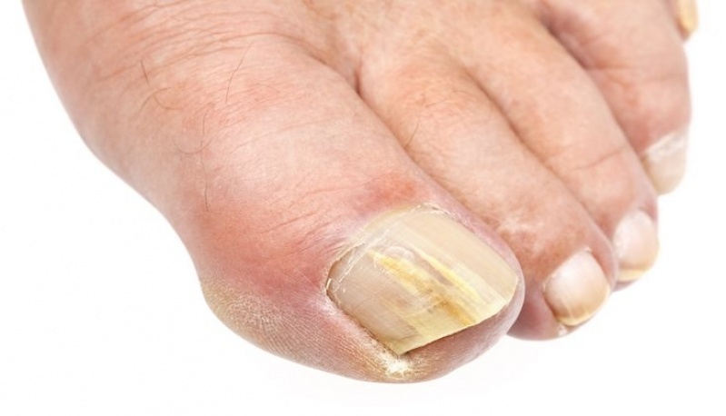 Tratamentos de Micose a Laser Raposo Tavares - Tratamento de Micose entre Os Dedos
