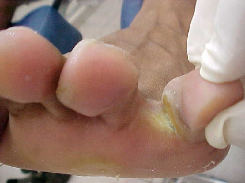 Tratamentos de Micose entre Os Dedos Vila Mariana - Tratamento Micose de Unha na Gravidez