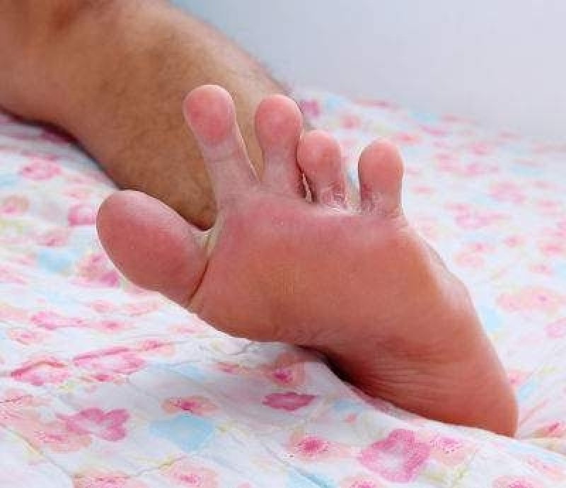 Tratamentos de Micoses e Frieiras Água Branca - Tratamento de Micose entre Os Dedos