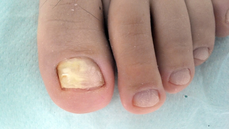 Tratamentos para Micose de Unha Grave Brás - Tratamento de Micose entre Os Dedos