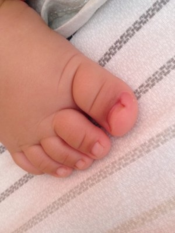 Tratamentos para Unha Encravada em Bebê Consolação - Tratamento de Unha Encravada com Granuloma
