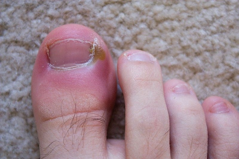 Unhas Encravadas em Idosos Saúde - Tratamento de Unha Encravada com Granuloma